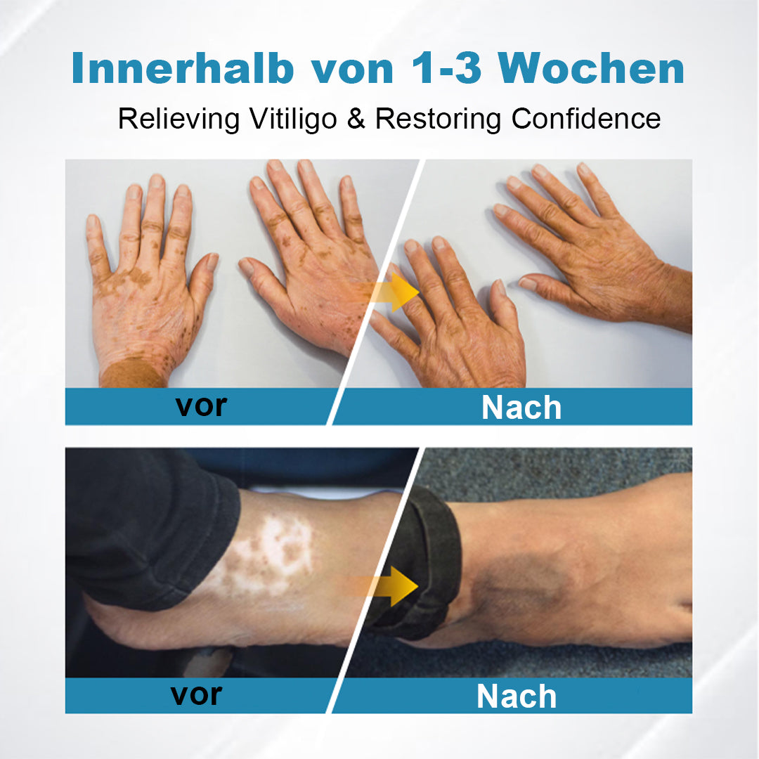 𝗡𝘂𝗿𝗯𝗶𝗻𝗶® 𝗗𝗲𝗿𝗺𝗮𝗕𝗲𝗮𝗺 𝗩𝗶𝘁𝗶𝗹𝗶𝗴𝗼 𝗧𝗵𝗲𝗿𝗮𝗽𝗶𝗲 𝗚𝗲𝗿ä𝘁