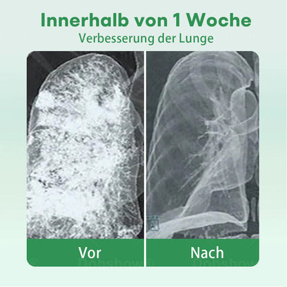 ✅Offizielles Geschäft|Cvreoz® Kräuter-Lungenreinigung Inhalieren(🫁Husten, Keuchen, Kurzatmigkeit, Auswurf, verstopfte Nase, Bronchitis, Bronchitis, Allergiesymptome, Lungenbeschwerden